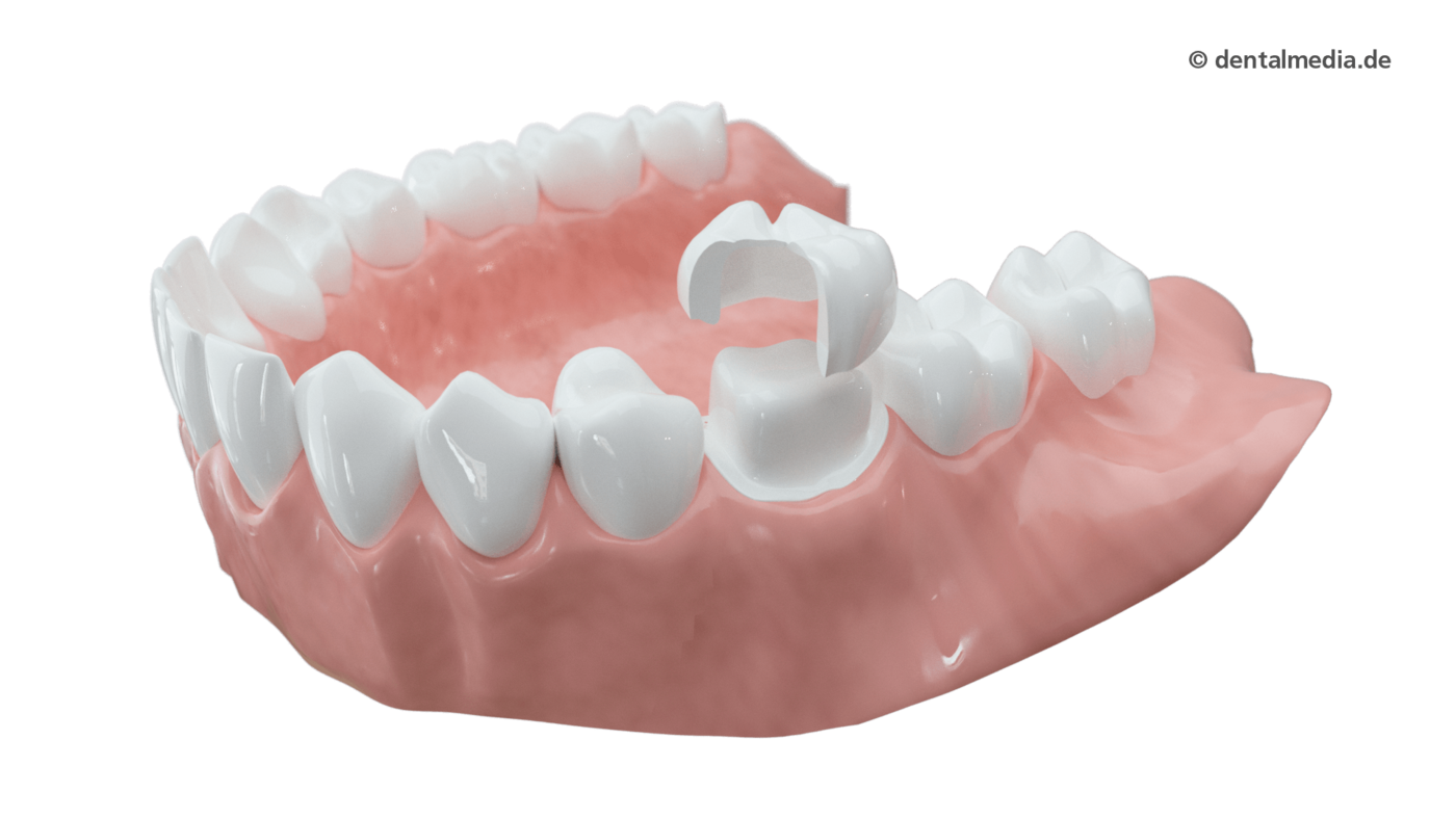 Vollkeramische Kronen  : Metallfreie Krone - komplett bestehend aus Hochleistungskeramik